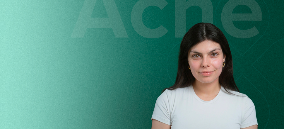 Akne LOBEY
