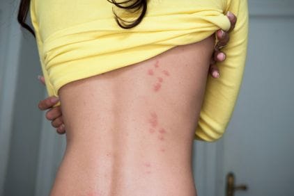 Укуси після сну: клопи та інші можливі причини