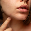 Neem Leaf Acne