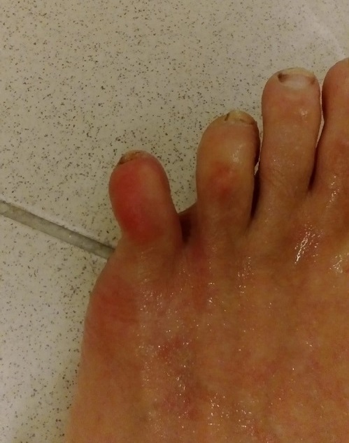 Zlomený malíček a lokální kryo