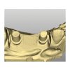 Implant Mask scan – gingiválna maska 5