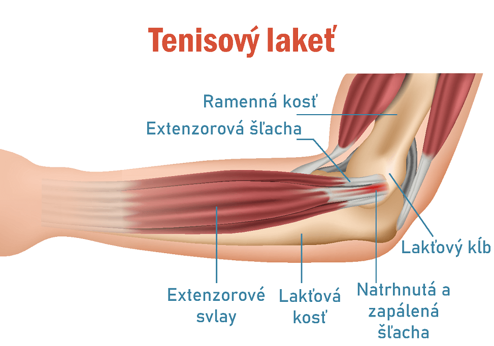 Tenisový lakeť: Príčiny, symptómy a efektívne cvičenia pre úľavu