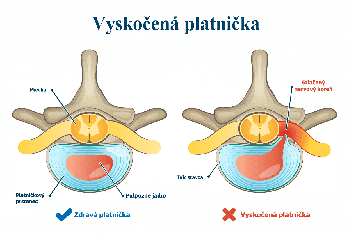 Vyskočená platnička (hernia disku): Príznaky, príčiny a liečba