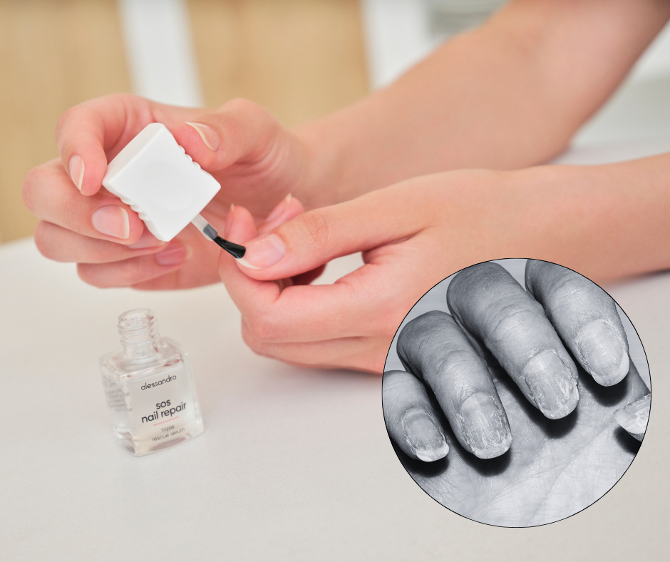 #blog - jak můžou kyseliny uzdravit zničené nehty