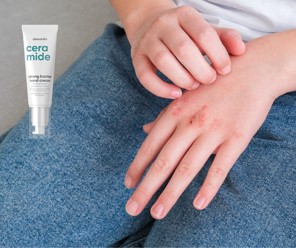 #blog - otestuj se, jestli máš oslabenou kožní bariéru