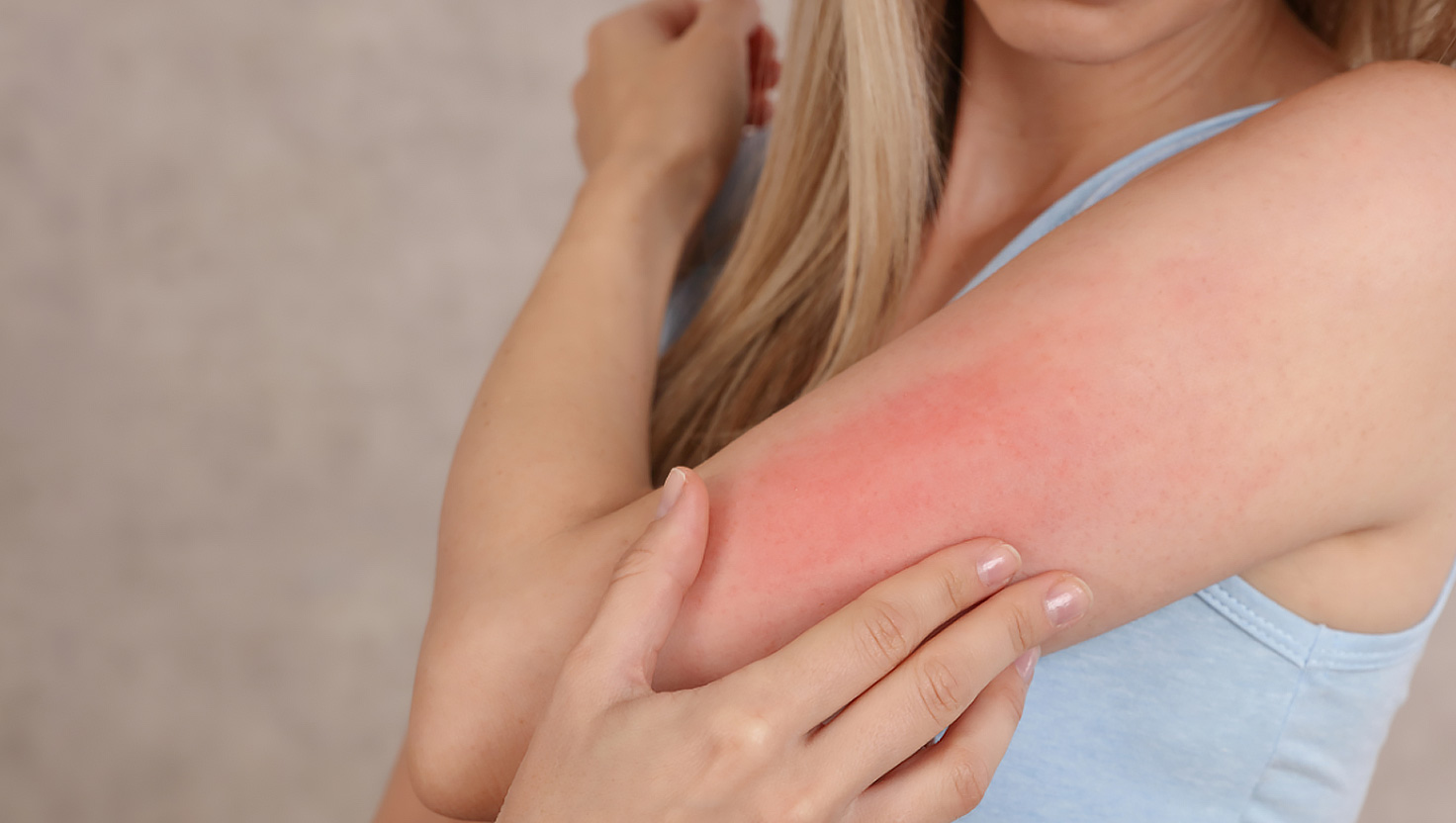 Kožná alergia: Príčiny, prejavy a účinné riešenia