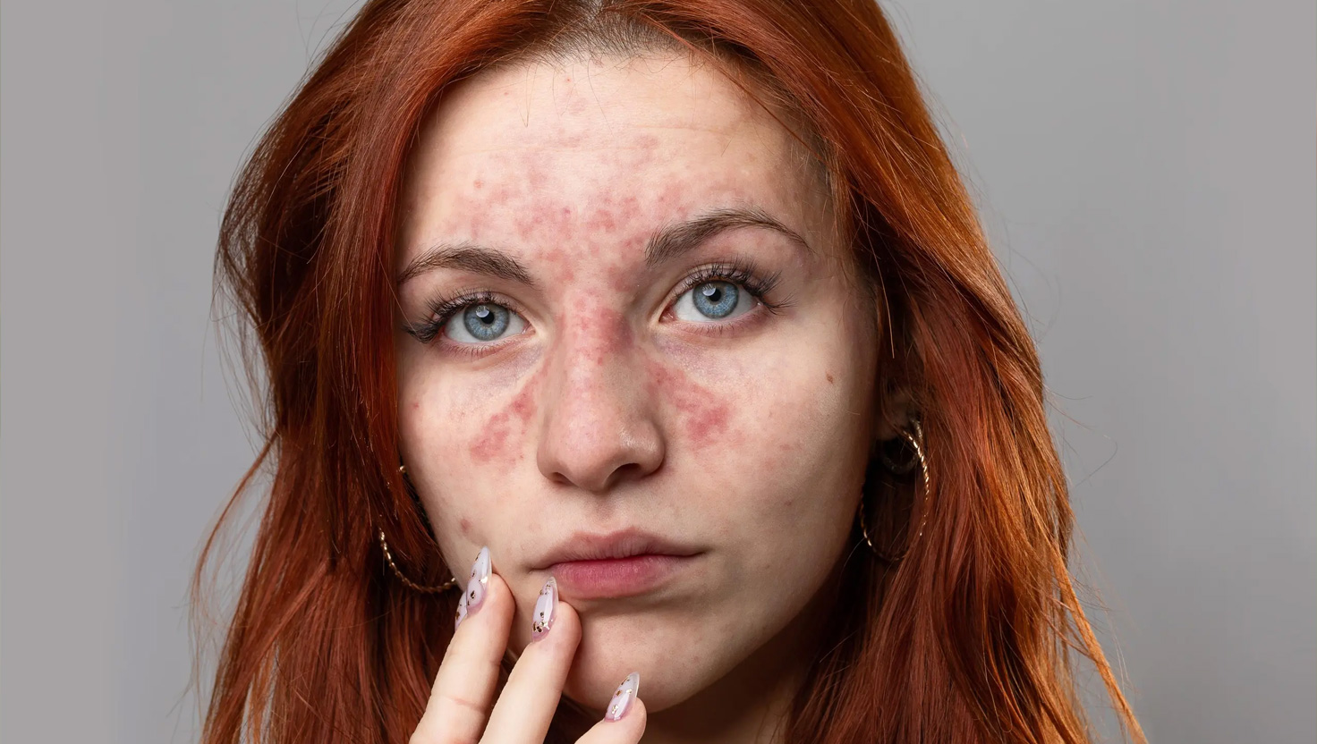 Atopický ekzém: Príčiny, príznaky a účinná liečba