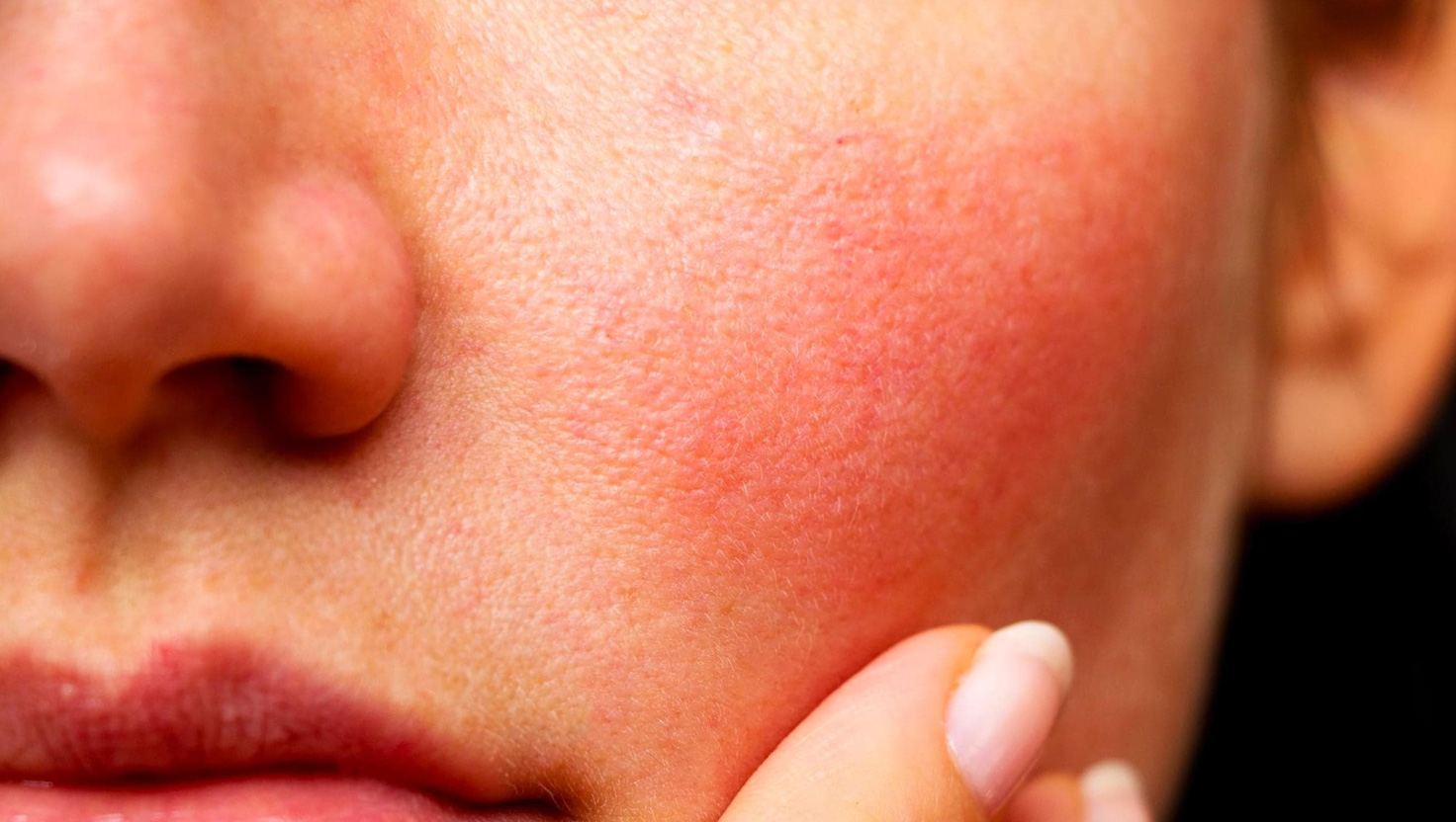 Červená pleť: Príčiny, starostlivosť a tipy na zmiernenie