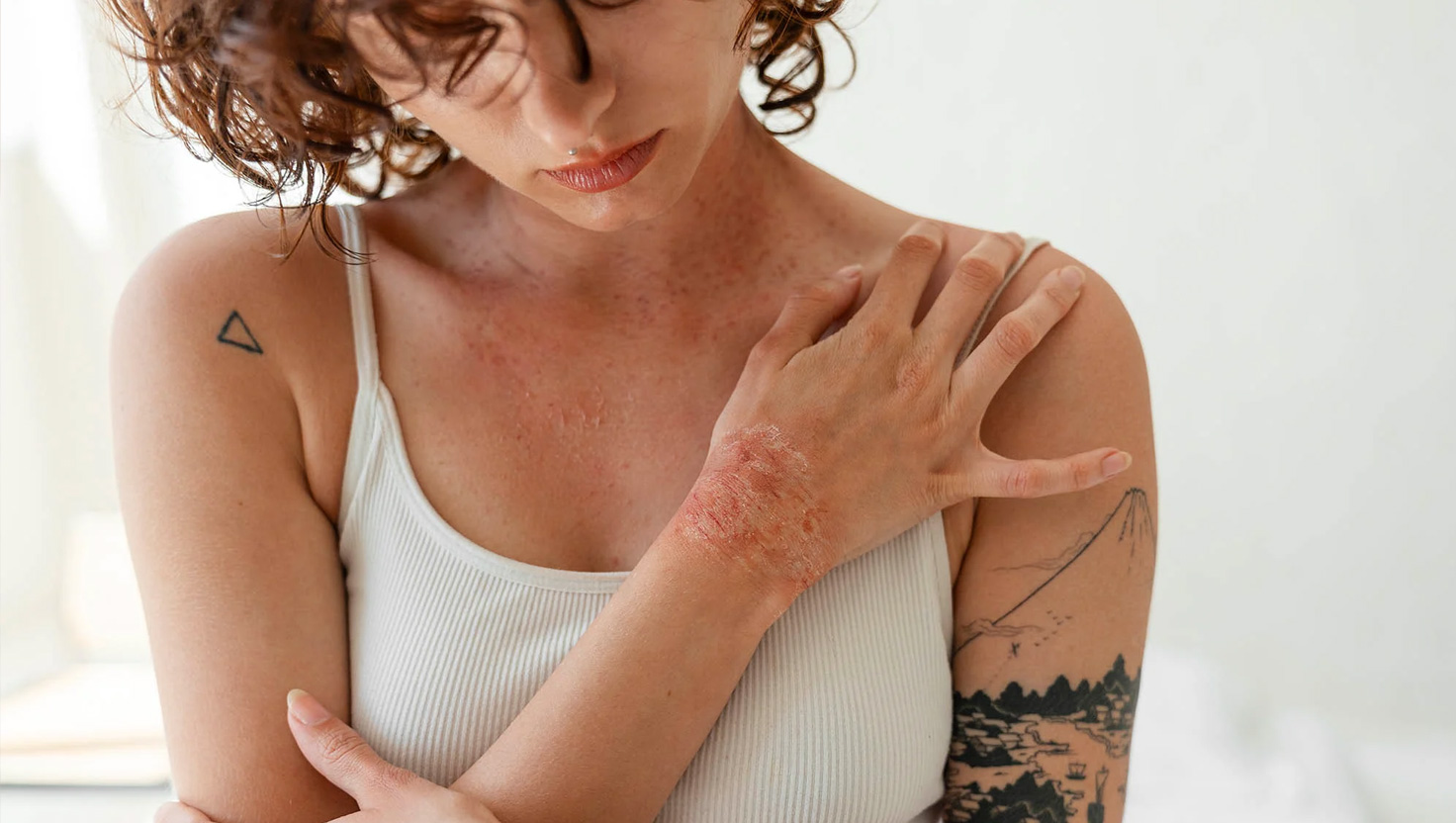 Dermatitída: Príčiny, príznaky a účinná liečba