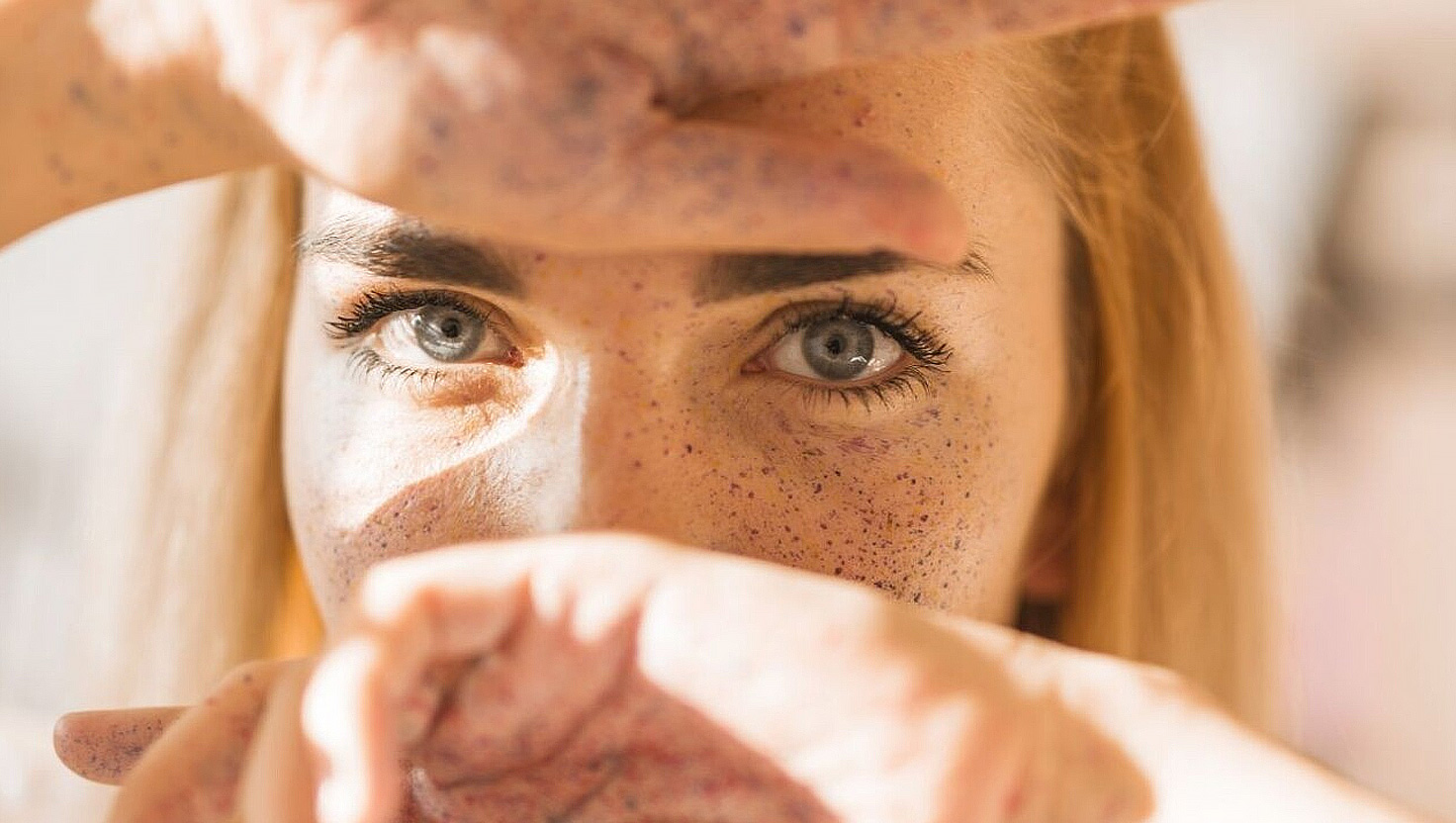 Fľaky na koži: Príčiny, prevencia a liečba