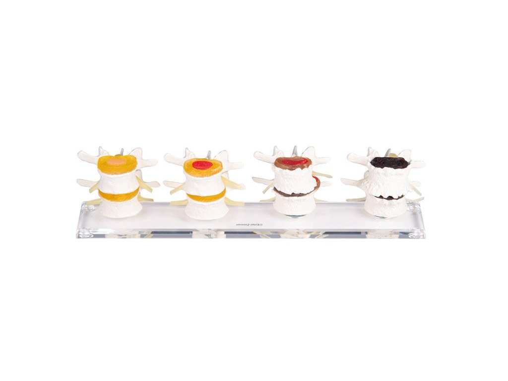 49356 anatomicky model degradacie medzi stavcovych diskov 7577 i erler zimmer