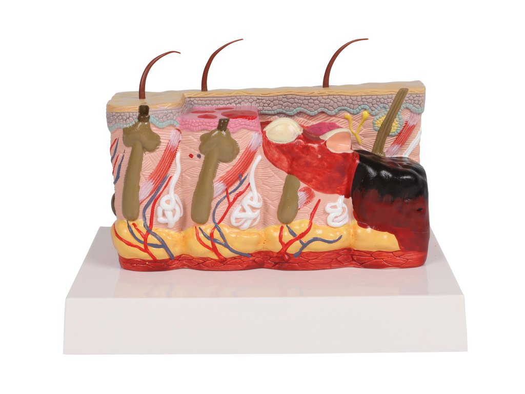 49575 pathologisches hautmodell mit verbrennung 1