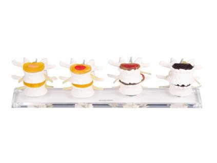 49356 49356 anatomicky model degradacie medzi stavcovych diskov 7577 i erler zimmer