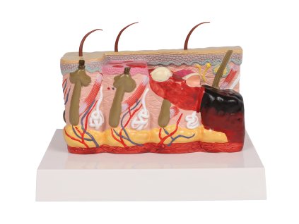 49575 49575 pathologisches hautmodell mit verbrennung 1