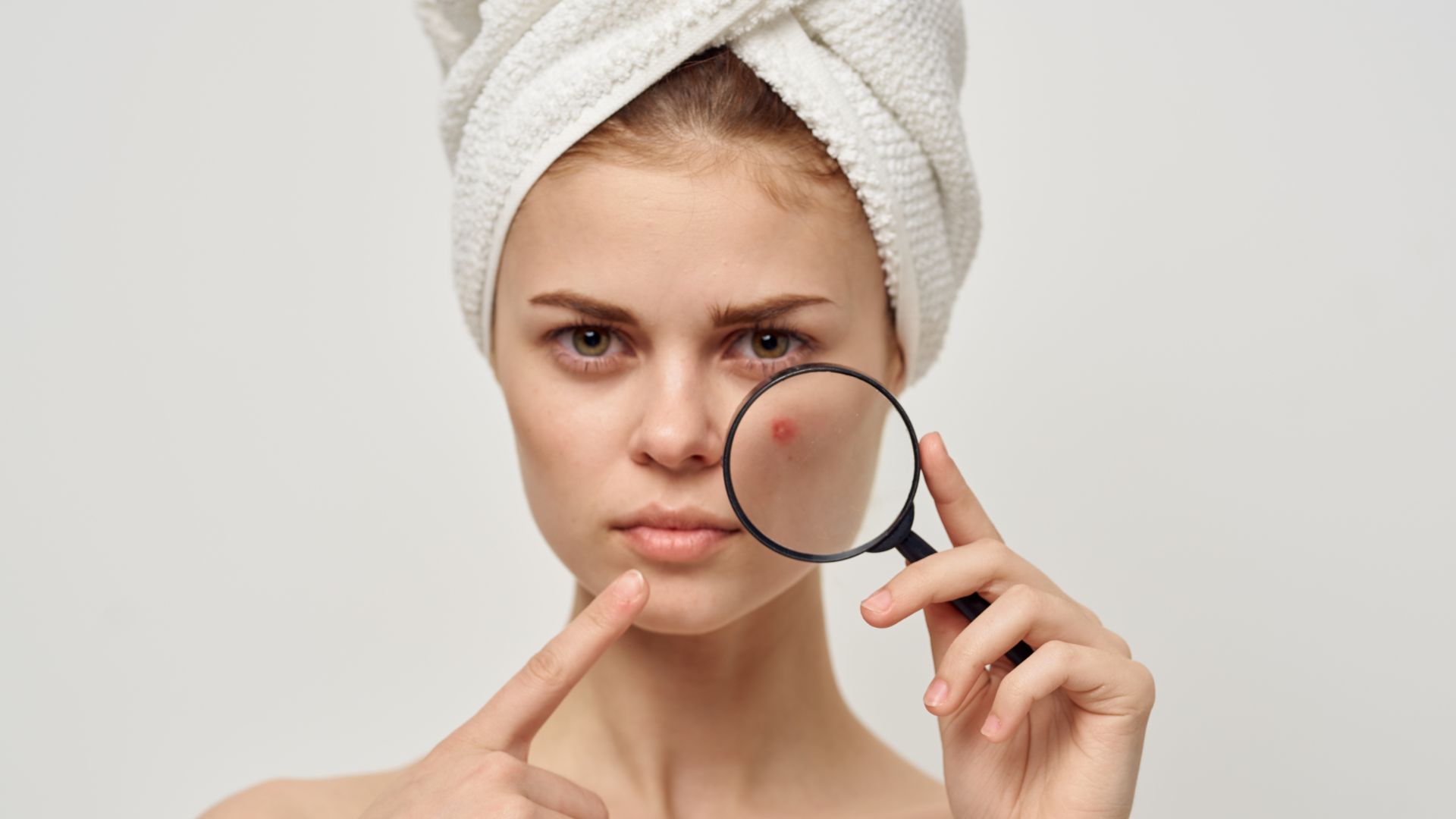 Akné: Kožné ochorenie, ktorého liečbu by ste nemali podceniť