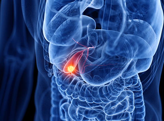 Ako sa zbaviť žlčníkových kameňov bez operácie?