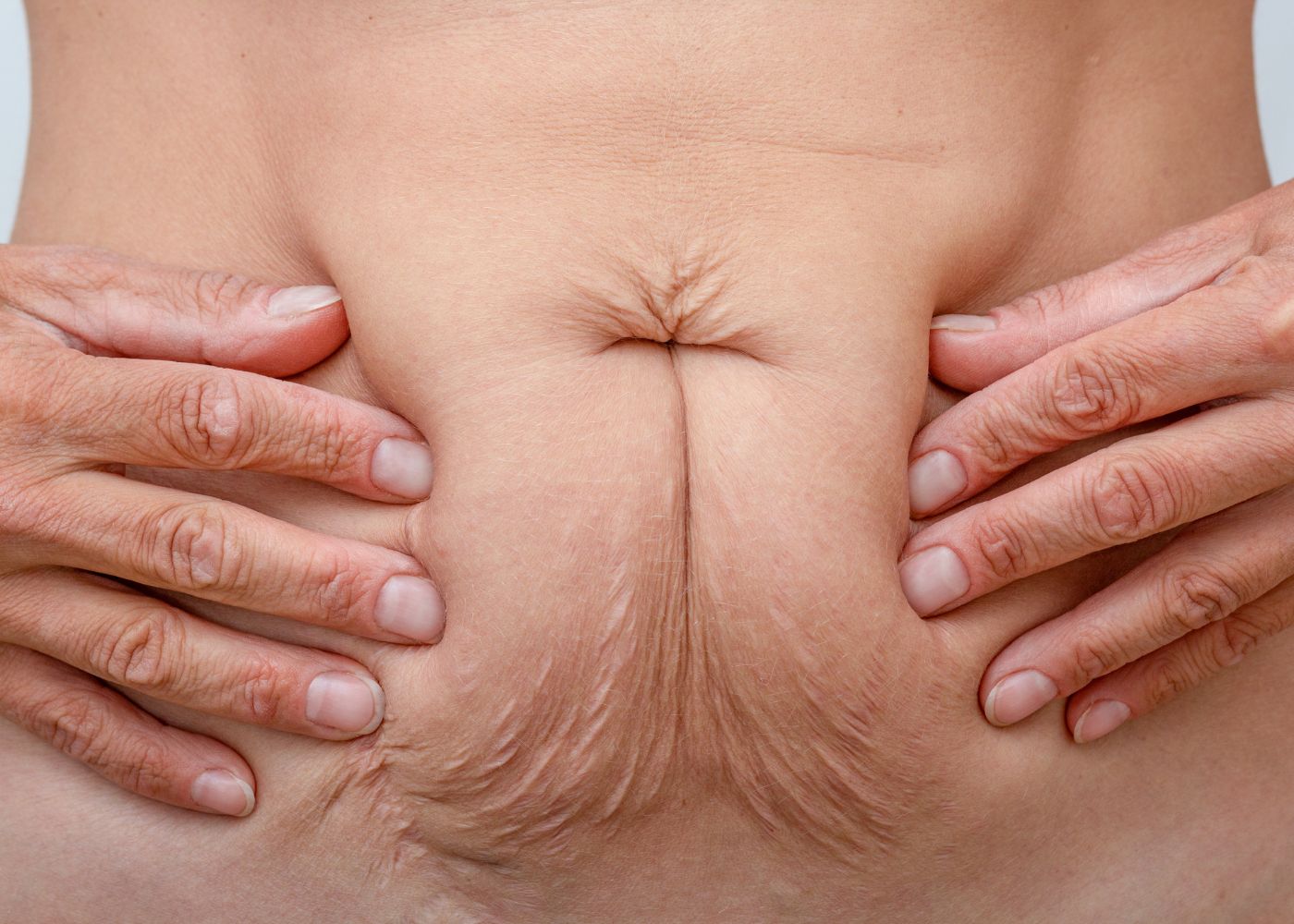 Jak zpevnit povislou kůži po hubnutí?