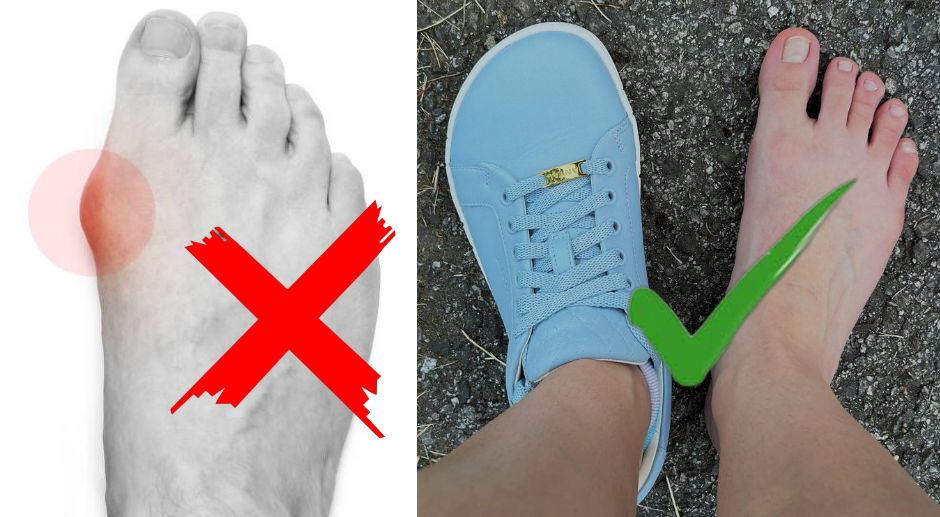 Uľavte svojim vbočeným palcom s barefoot topánkami Antal!