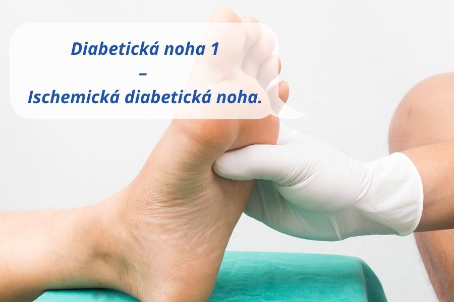 Syndróm diabetickej nohy - Ischemická diabetická noha