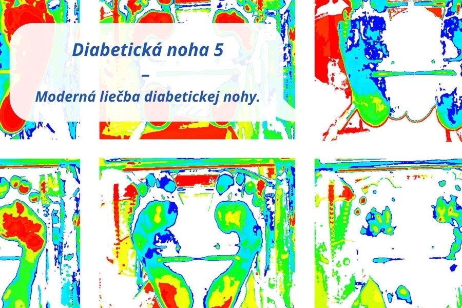 Moderné metódy liečby diabetickej nohy