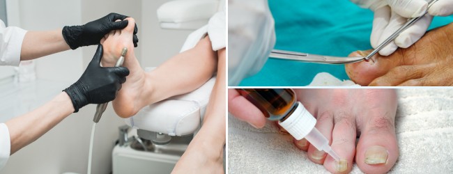 plesen-na-nohach-prevencia-4