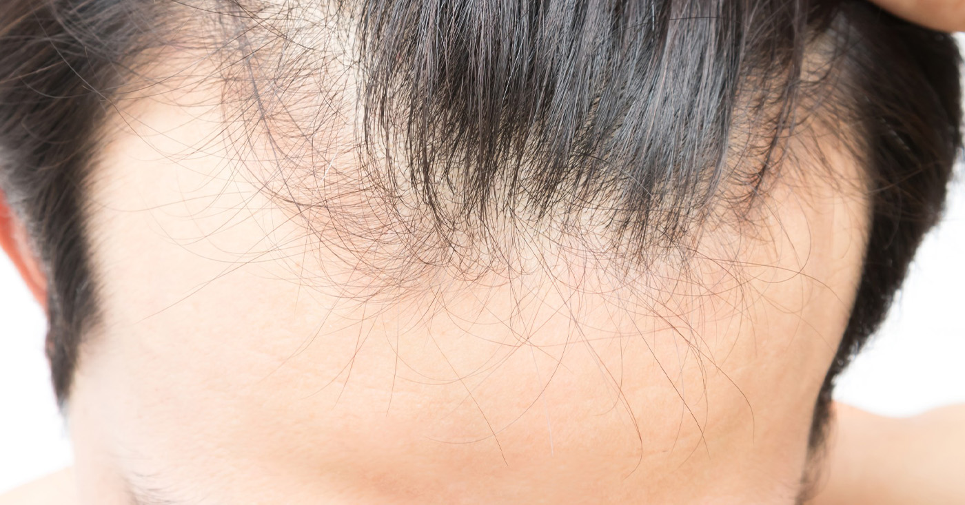 Padání vlasů – proč k tomu dochází a jak ho efektivně zastavit