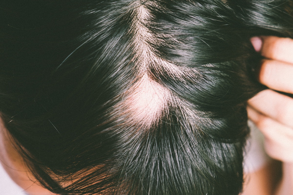 Typy alopecie: Kompletní přehled forem vypadávání vlasů a jejich léčba