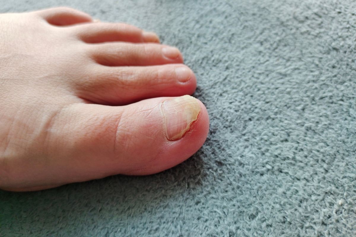 Mykóza nohou v zimě: Proč uzavřená obuv nahrává plísním?