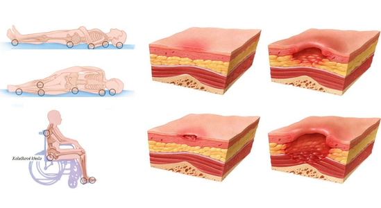 Dekubity - Poraďte si skôr, ako začnú ohrozovať život!