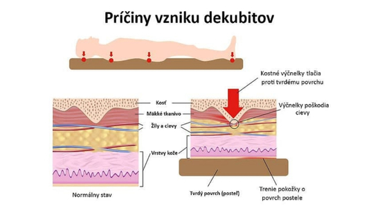 Prevencia a ošetrovanie preležanín a dekubitov