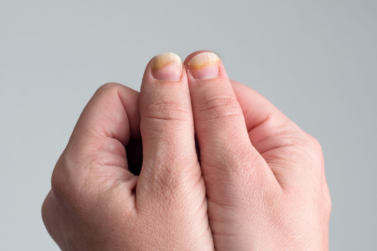 Ako predchádzať plesniam nechtov a včas rozpoznať prvé príznaky mykózy