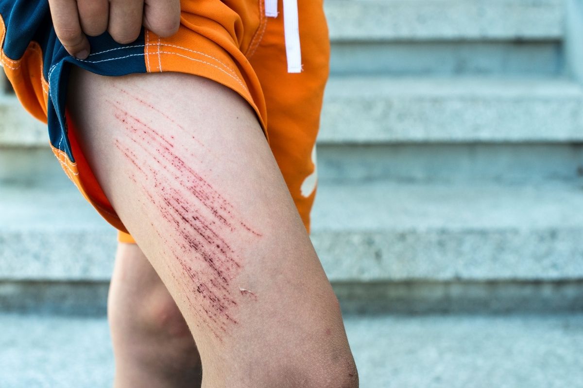 Ako správne ošetriť drobnú ranu: postup krok za krokom