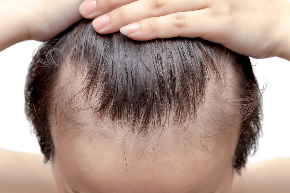 Vlasová línia a kúty: Prvé signály androgénnej alopécie?