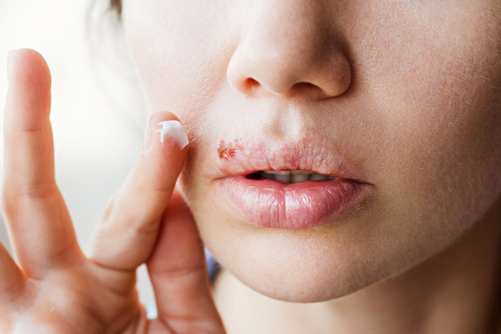 Aj vás sa zmocní nervozita pri slove opar? Viete o tom, že sa dá  liečiť aj prírodnou cestou?