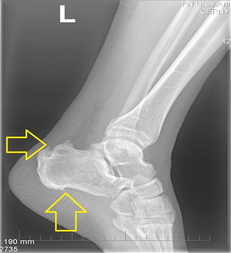 Co to je patní ostruha, jak vzniká a jak se léčí?