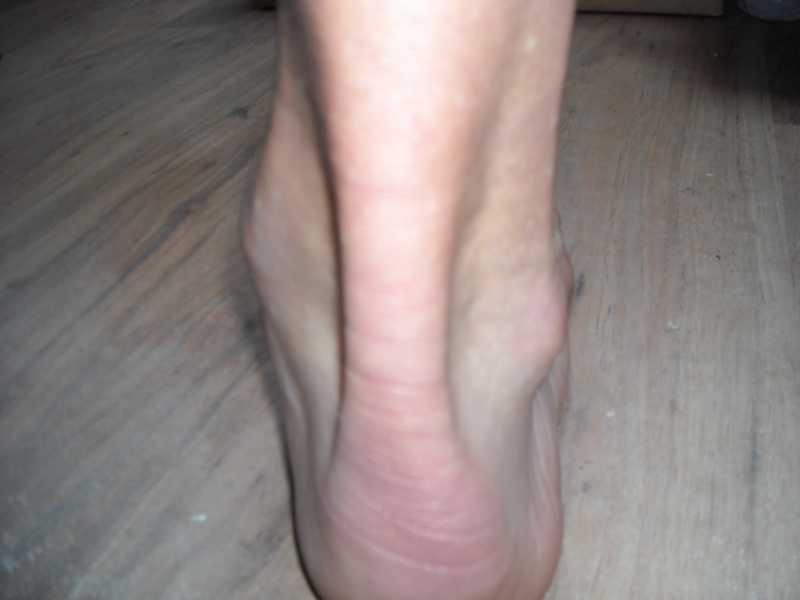 Poranění Achillovy šlachy