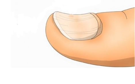 Nehty na nohou ve tvaru lžičky