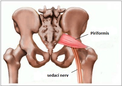 Piriformis syndrom (falešný ischias) a jak se léčí?
