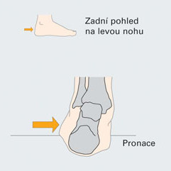 Co to je nadměrná pronace a jaký má vliv na náš běh?