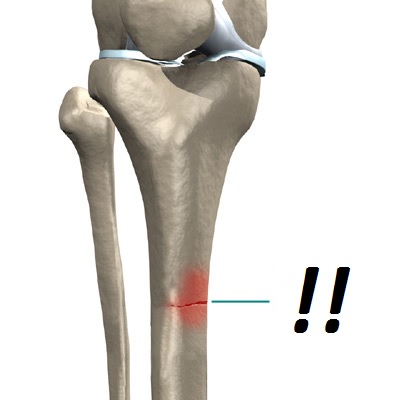Optimální zátěž pro léčbu nízkorizikových zranění tibie a metatarzální kůstek u běžců