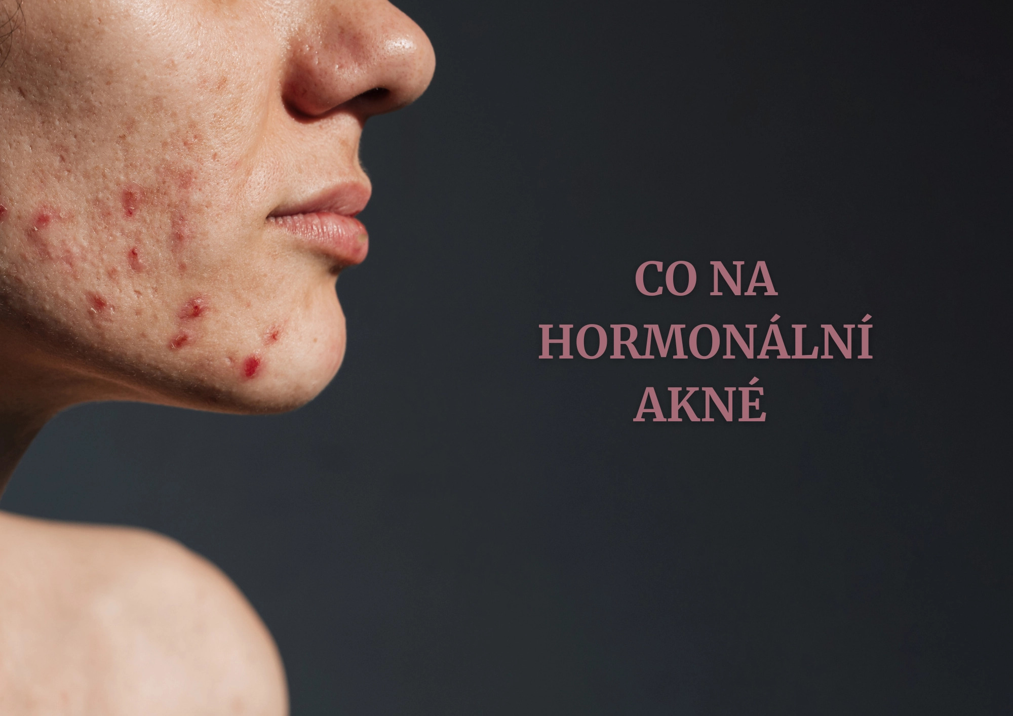 Co na hormonální akné?
