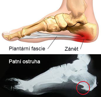 Plantární fascitida a patní ostruha