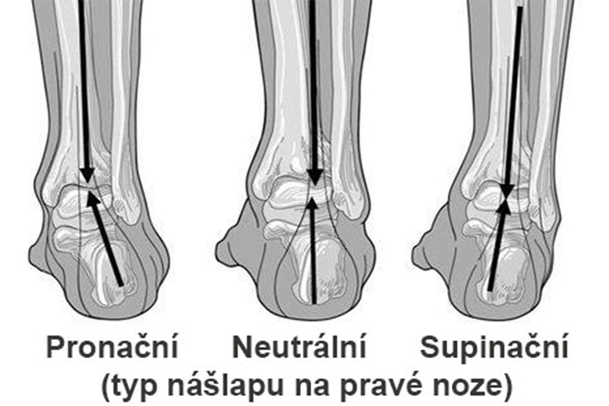 Jaký typ nášlapu máte? Co je pronace?