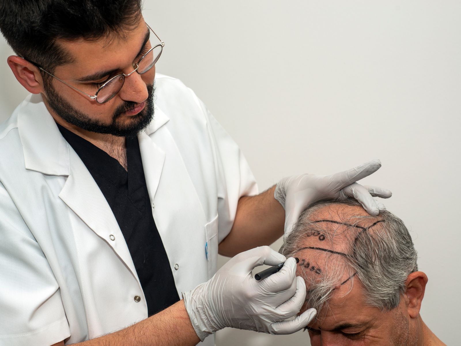 Transplantace vlasů