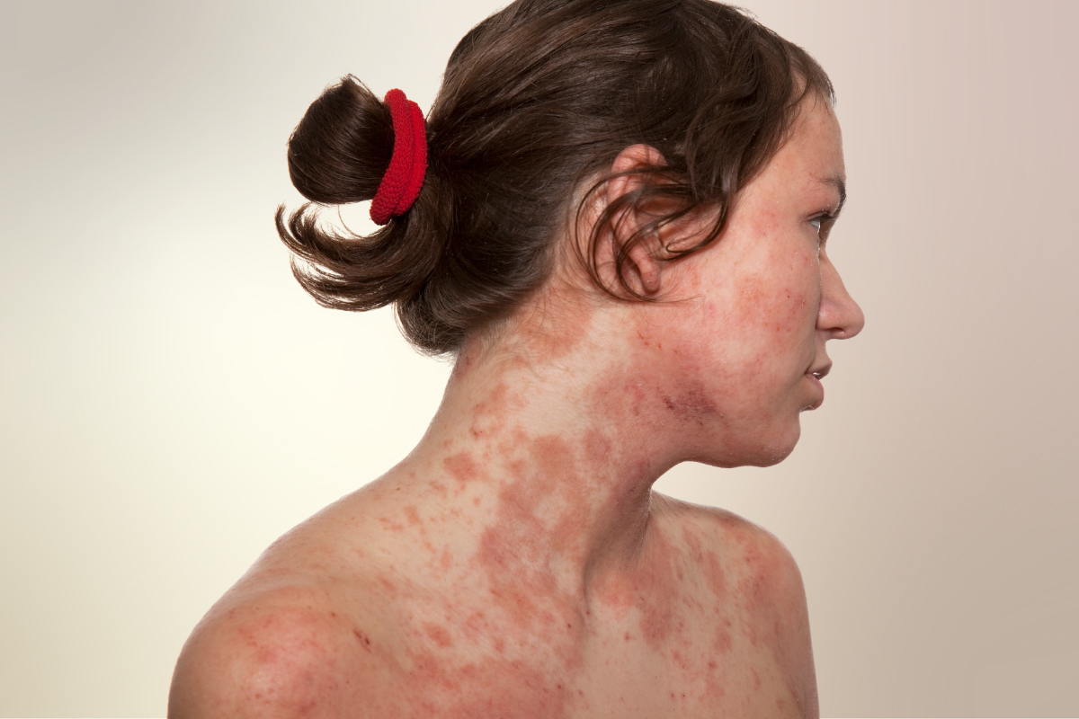 Ekcéma és atópiás dermatitisz: Miért érdemes dermonutraceutikumért nyúlni