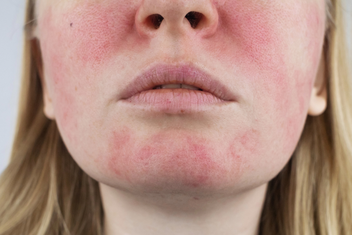 ROSACEA: Amikor ég az arc és csökken az önbizalom: a kulcs a hisztamin kontrollálása lehet?
