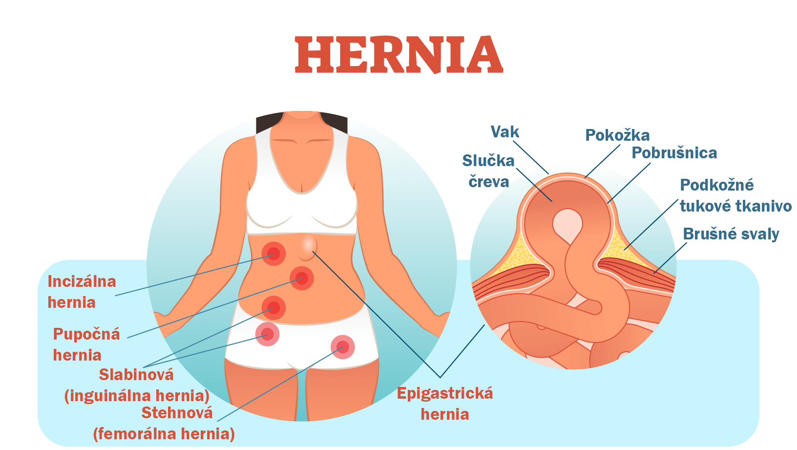Hernia (pruh, prietrž): Príznaky, príčiny a liečba