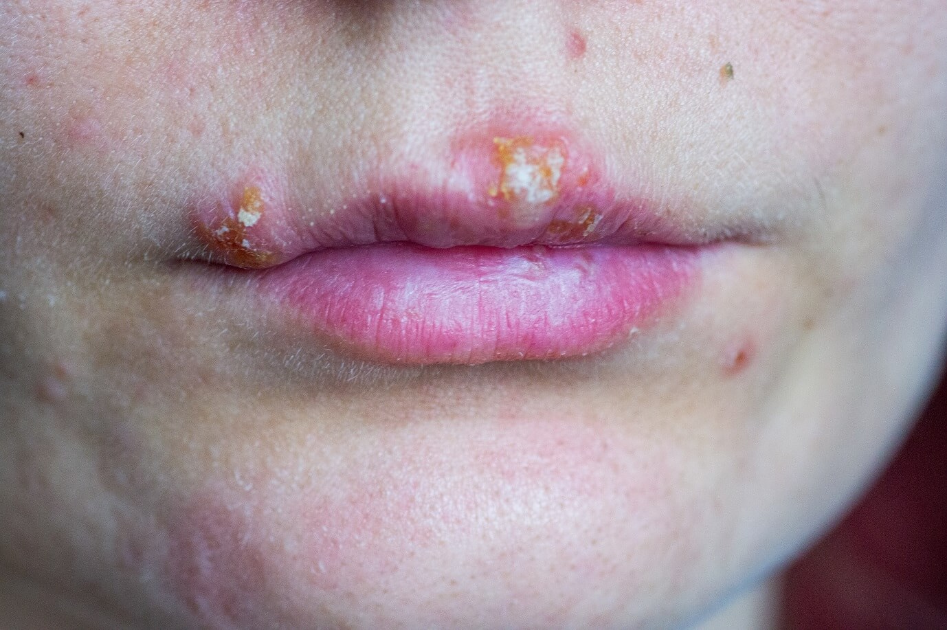 Herpes: Príčiny a  spôsoby ako sa ho zbaviť