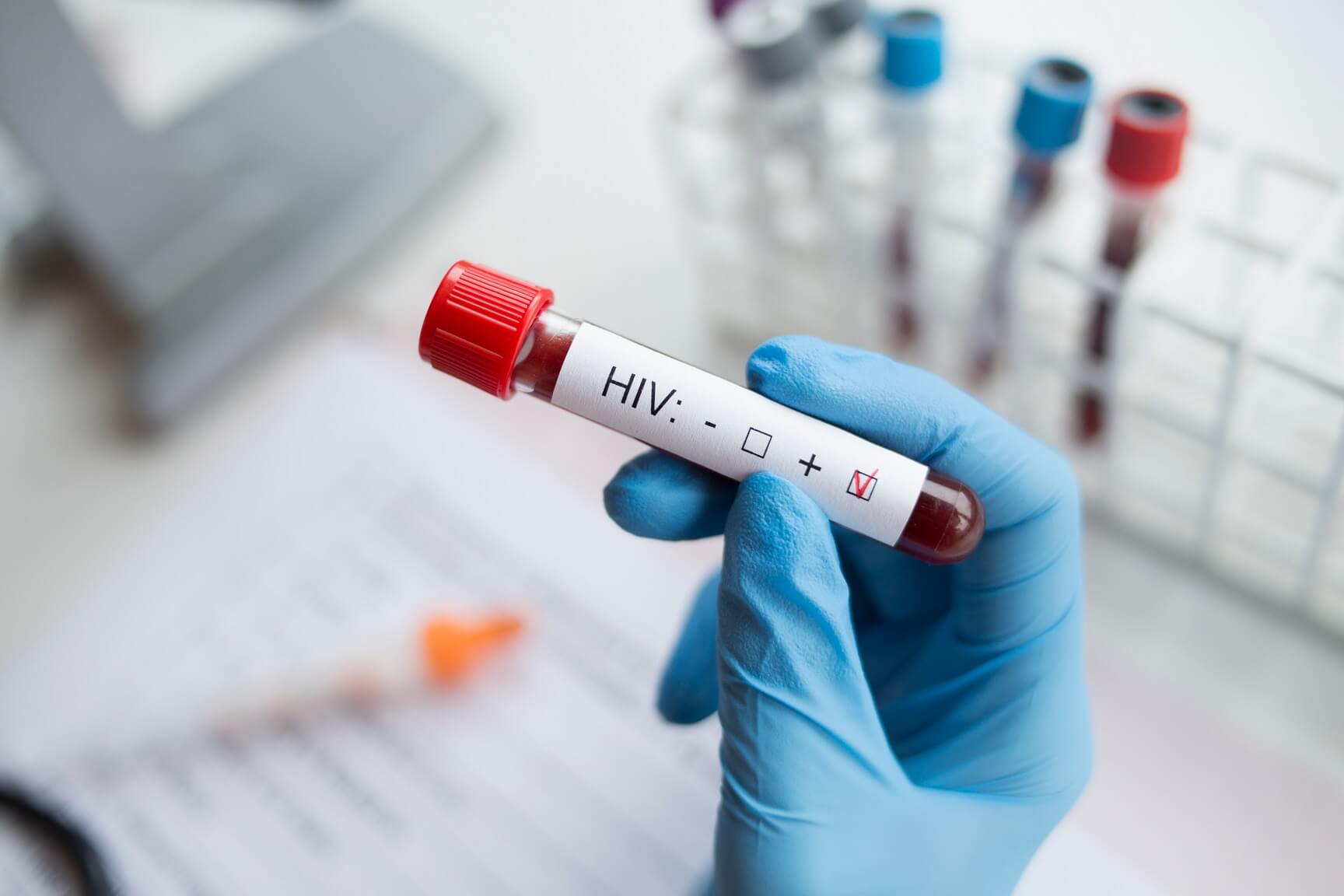 HIV: Príznaky, príčiny a liečba