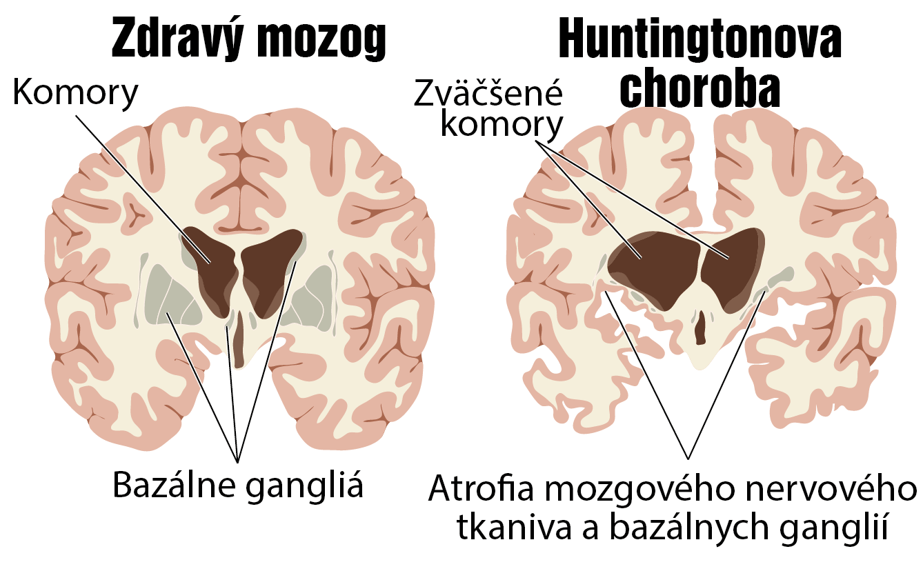 Huntingtonova choroba: Príznaky, príčiny a liečba